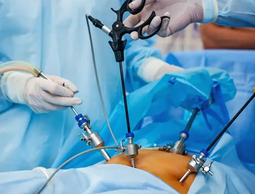Laparoscopic Surgery in Pimpri Chinchwad